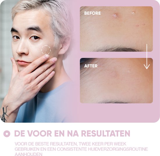 Breakout+aid microneedle patches - voor het gezicht - tegen pigmentvlekken en onzuiverheden - 9 stuks